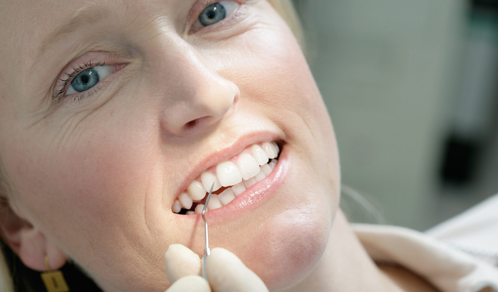 Neben den entwicklungsbedingten Ursachen für schiefe Zähne bei Kindern gibt es auch typische Gründe, die speziell auf Erwachsene zutreffen.